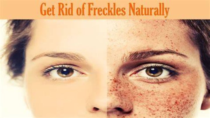Can I bleach my freckles?