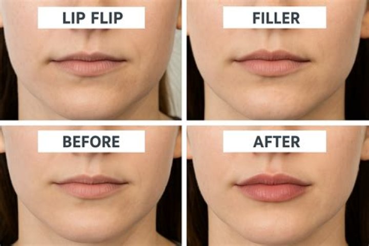 Can you do lip filler and lip flip same time?