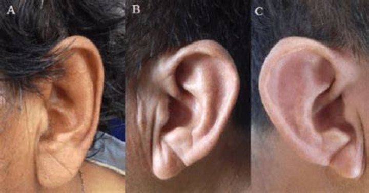 Can you make your Earfold?
