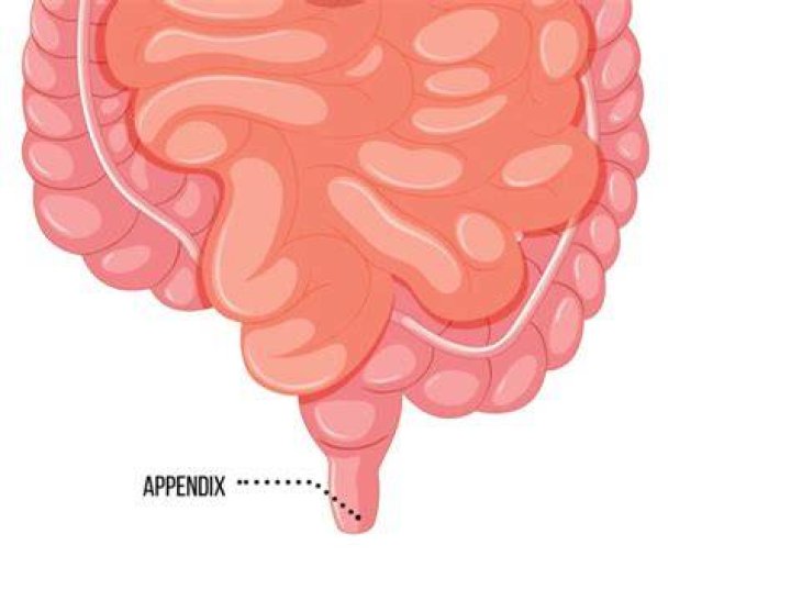 Do astronauts get appendix removed?