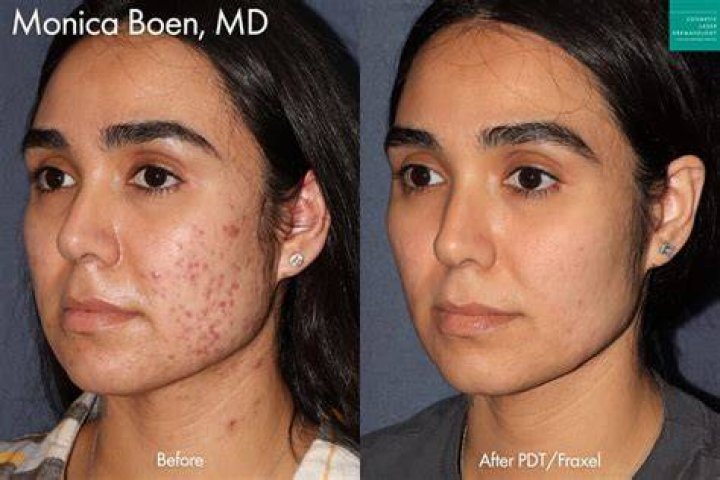 Do brown scars fade?