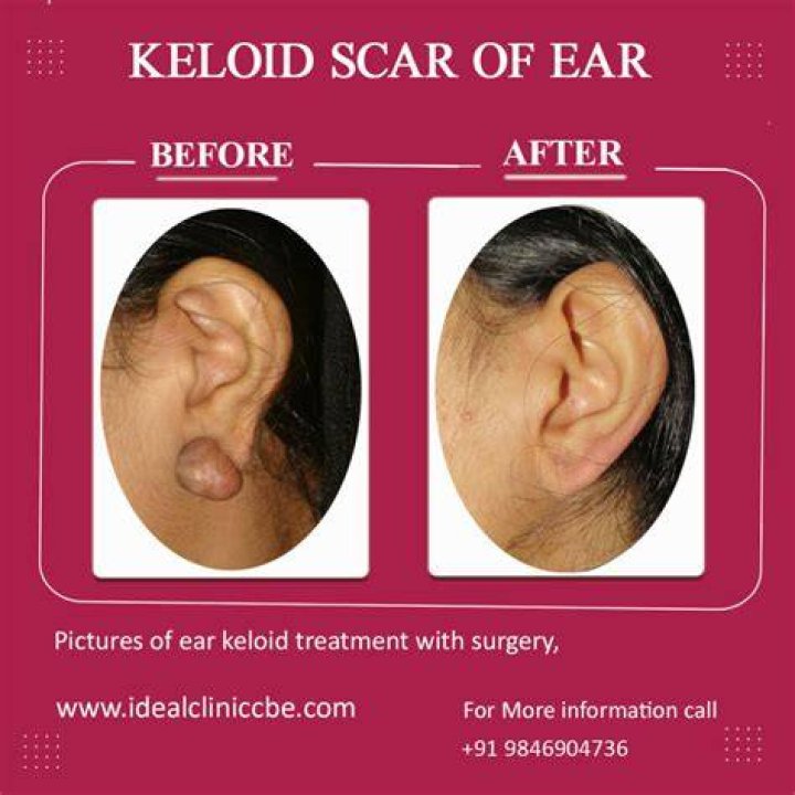 Do keloids grow forever?