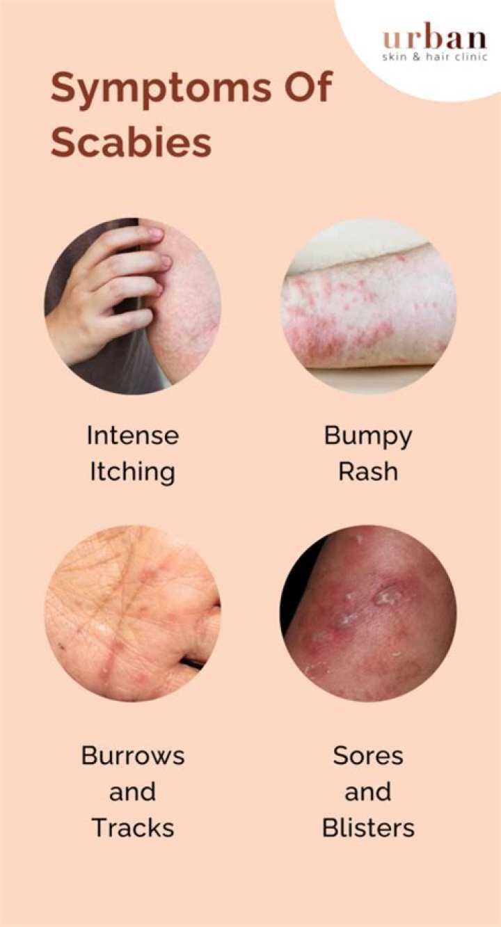 Does the scabies rash always itch?