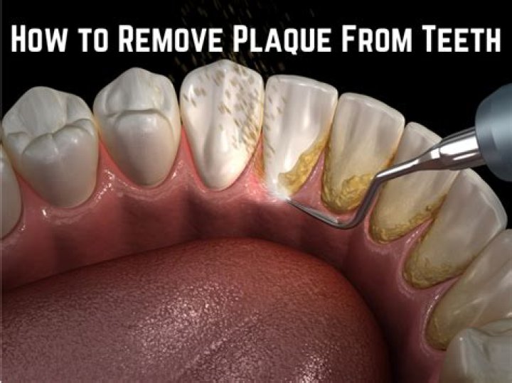 How do you get build up off teeth?