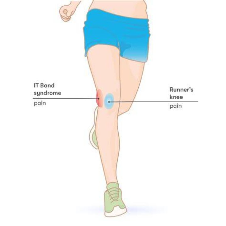 How do you get runners knee?