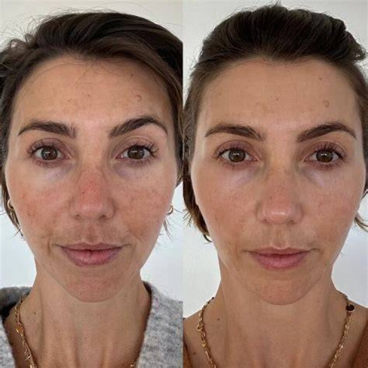 How do you lighten skin after microneedling?