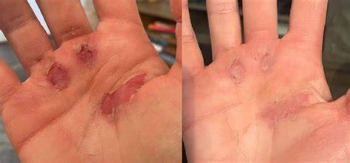 How long do hand rips take to heal?