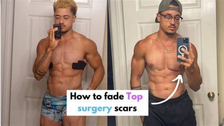 When can I stop covering my nipples after top surgery?